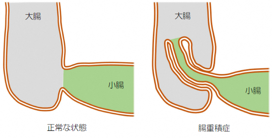 腸重積症説明イラスト